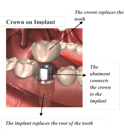 THE-COST-OF-DENTAL-IMPLANTS