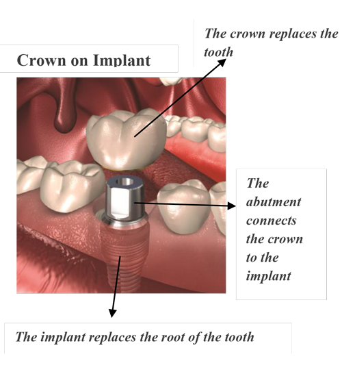 dental implants montreal cost