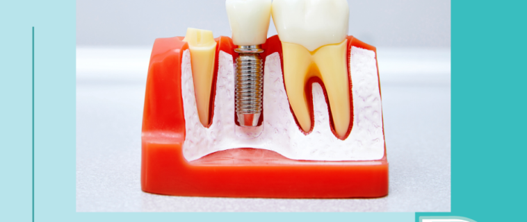 Trivia : Implants Dentaires
