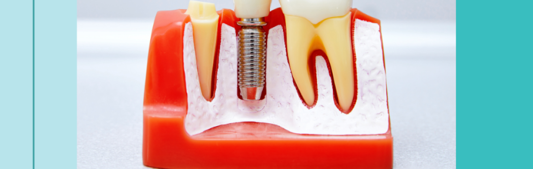 Trivia : Implants Dentaires