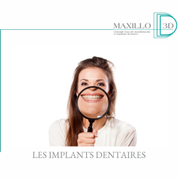 Les avantages des implants dentaires