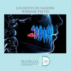 Pourquoi extraire les dents de sagesse ?