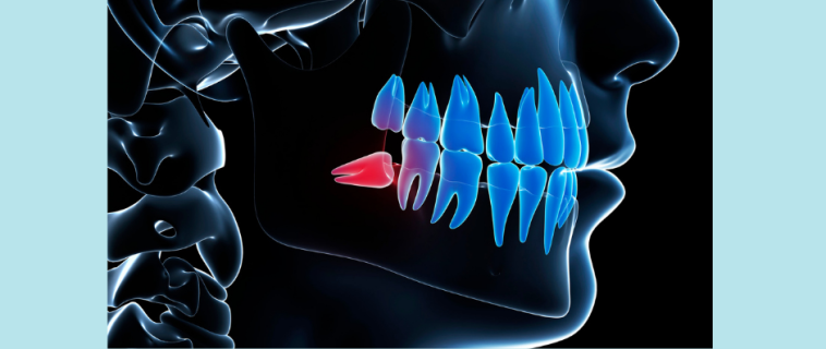 Pourquoi extraire les dents de sagesse ?