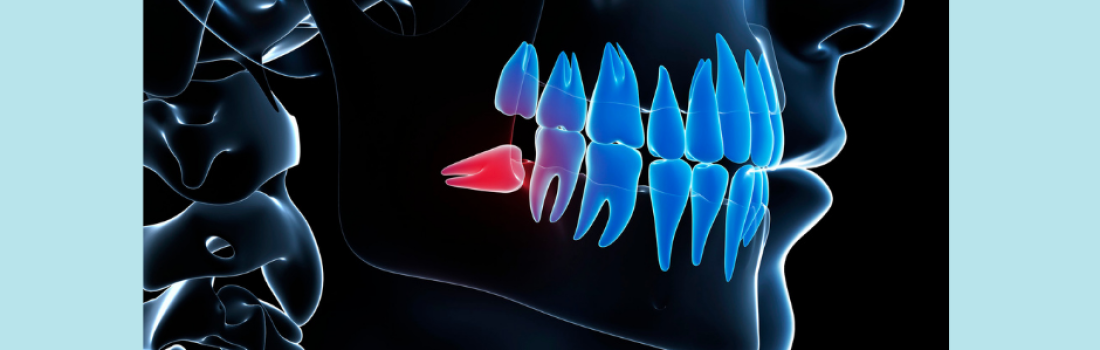 Pourquoi extraire les dents de sagesse ?