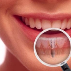 Comprendre le coût des implants dentaires