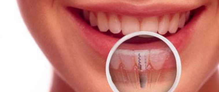 Understanding the cost of dental implants