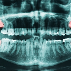 Managing your wisdom teeth is the wisest choice!